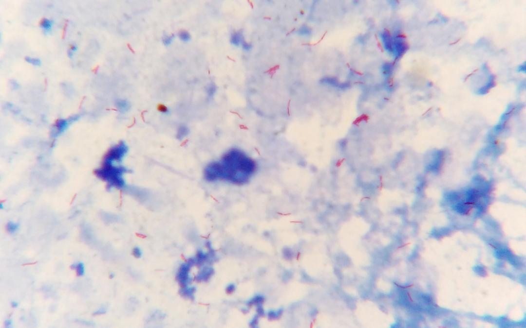 AFB Smears and Cultures: What Do the Tests Actually Mean?